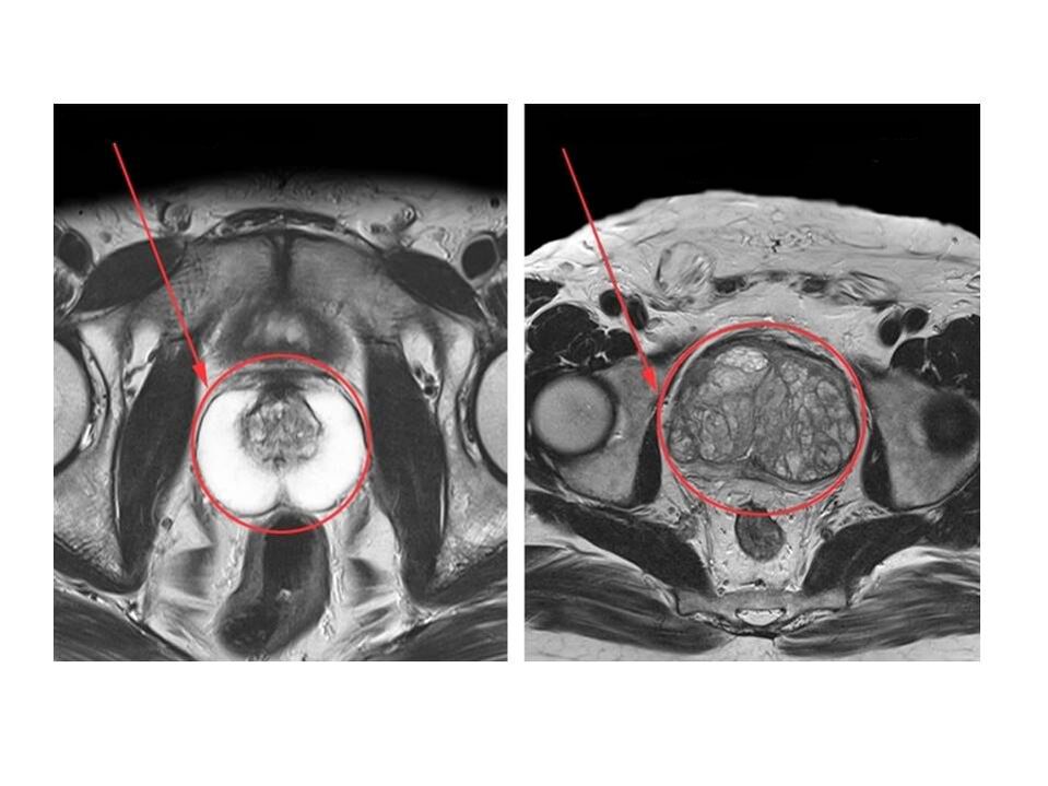 Сравнение на здрава (вляво) и възпалена (вдясно) простата върху ЯМР изображения